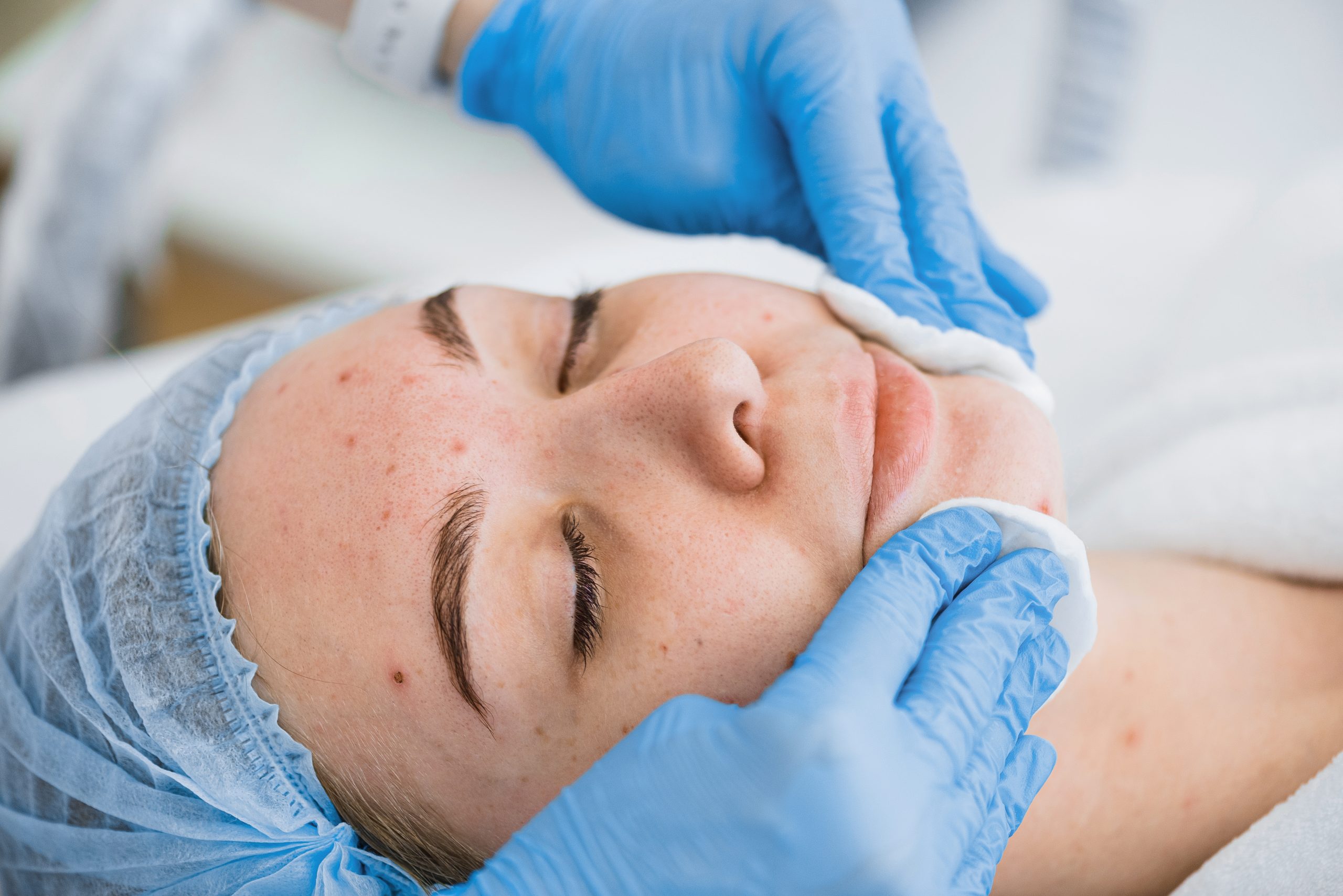 Patient’s facial skin before receiving a chemical peel at Just Lose Weight MD Clinic, showing uneven tone, fine lines, and acne scars.