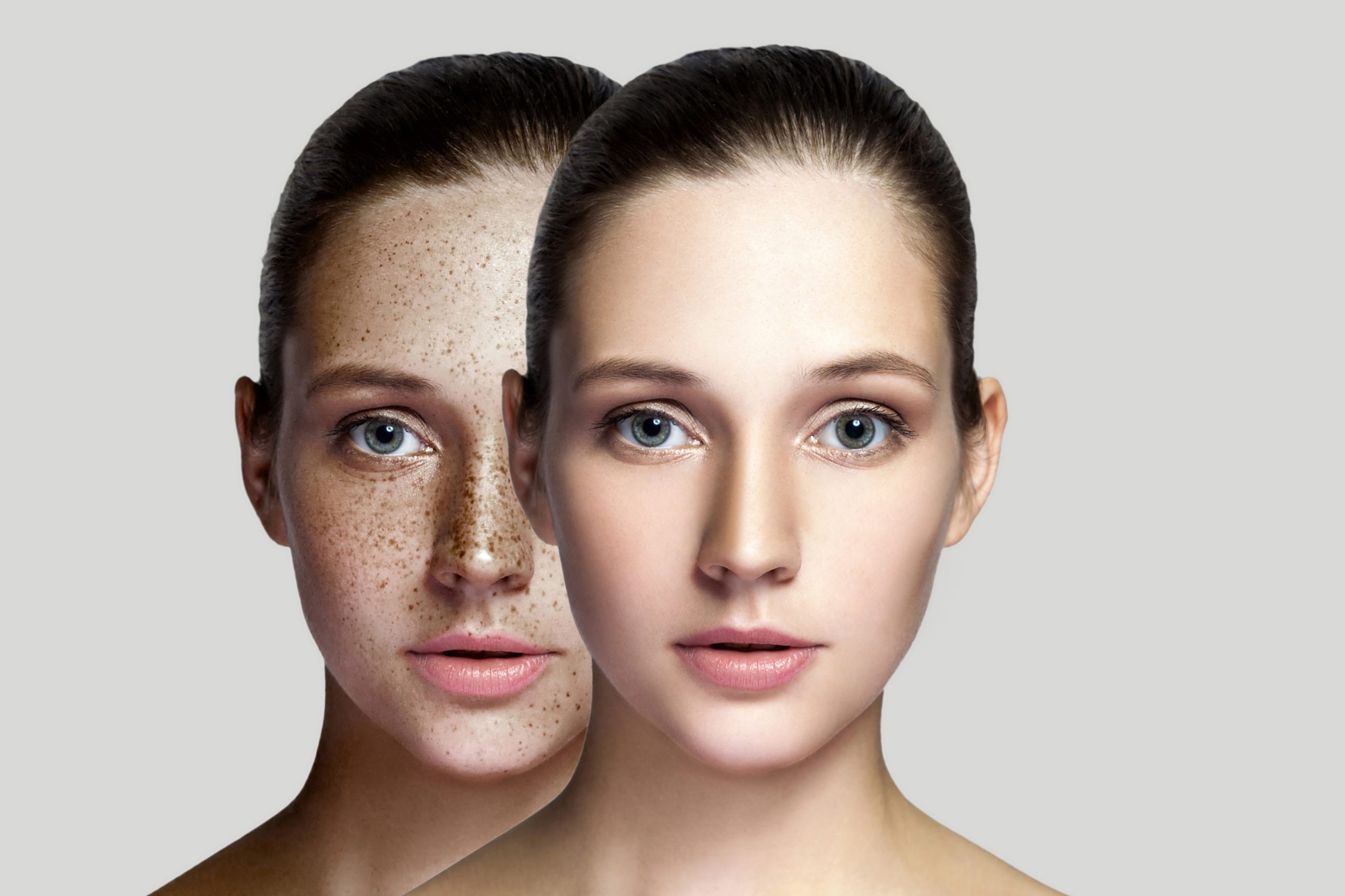 Before and after results of a professional chemical peel treatment at Just Lose Weight MD Clinic, showing improved skin tone and texture.