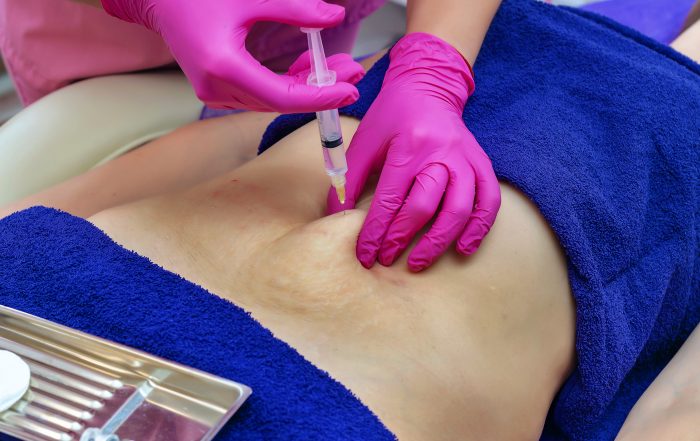 Non-surgical fat dissolving injections near me at Just Lose Weight MD Clinic